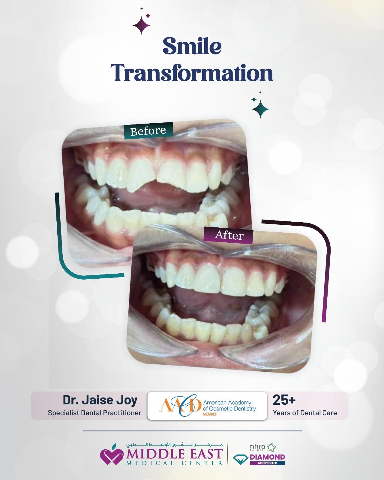 Perfect smile makeover